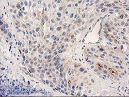 PLEKHA3 Antibody - IHC of paraffin-embedded Carcinoma of Human bladder tissue using anti-PLEKHA3 mouse monoclonal antibody.