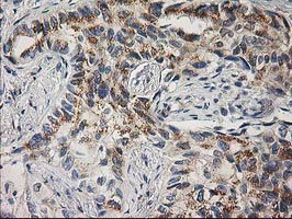 PLEKHA3 Antibody - IHC of paraffin-embedded Carcinoma of Human lung tissue using anti-PLEKHA3 mouse monoclonal antibody.
