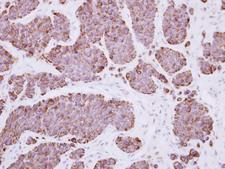 PLEKHF2 Antibody - IHC of paraffin-embedded Breast ca, using PLEKHF2 antibody at 1:500 dilution.