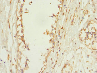 PLEKHF2 Antibody - Immunohistochemistry of paraffin-embedded human breast cancer at dilution 1:100