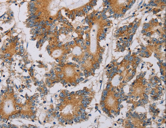 PLEKHG6 Antibody - Immunohistochemistry of paraffin-embedded Human colon cancer using PLEKHG6 Polyclonal Antibody at dilution of 1:20.