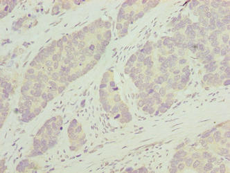 PLEKHJ1 Antibody - Immunohistochemistry of paraffin-embedded human gastric cancer using PLEKHJ1 Antibody at dilution of 1:100