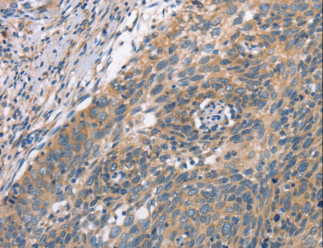PLEKHO1 / CKIP-1 Antibody - Immunohistochemistry of paraffin-embedded Human cervical cancer using PLEKHO1 Polyclonal Antibody at dilution of 1:70.