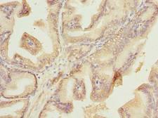 PLET1 / C11orf34 Antibody - Immunohistochemistry of paraffin-embedded human prostate cancer using antibody at dilution of 1:100.
