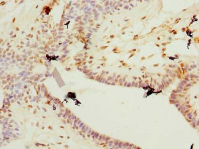 PLET1 / C11orf34 Antibody - Immunohistochemistry of paraffin-embedded human breast cancer using antibody at dilution of 1:100.