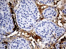PLG / Plasmin / Plasminogen Antibody - Immunohistochemical staining of paraffin-embedded Carcinoma of Human pancreas tissue using anti-PLG mouse monoclonal antibody. (Heat-induced epitope retrieval by 1mM EDTA in 10mM Tris buffer. (pH8.5) at 120°C for 3 min. (1:500)