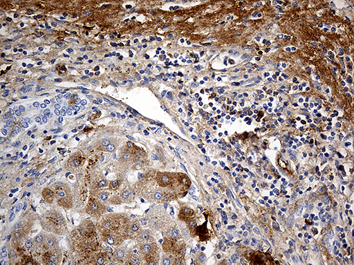 PLG / Plasmin / Plasminogen Antibody - Immunohistochemical staining of paraffin-embedded Human liver tissue within the normal limits using anti-PLG mouse monoclonal antibody. (Heat-induced epitope retrieval by 1mM EDTA in 10mM Tris buffer. (pH8.5) at 120°C for 3 min. (1:500)
