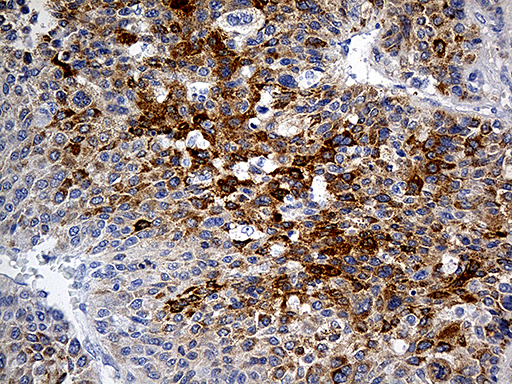 PLG / Plasmin / Plasminogen Antibody - Immunohistochemical staining of paraffin-embedded Carcinoma of Human liver tissue using anti-PLG mouse monoclonal antibody. (Heat-induced epitope retrieval by 1mM EDTA in 10mM Tris buffer. (pH8.5) at 120°C for 3 min. (1:500)