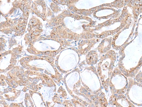 PLGLB2 / PLGLB1 Antibody - Immunohistochemistry of paraffin-embedded Human thyroid cancer tissue  using PLGLB2 Polyclonal Antibody at dilution of 1:65(×200)