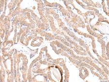 PLGLB2 / PLGLB1 Antibody - Immunohistochemistry of paraffin-embedded Human thyroid cancer tissue  using PLGLB2 Polyclonal Antibody at dilution of 1:35(×200)