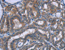 PLIN1 / Perilipin Antibody - Immunohistochemistry of paraffin-embedded Human colon cancer using PLIN1 Polyclonal Antibody at dilution of 1:30.