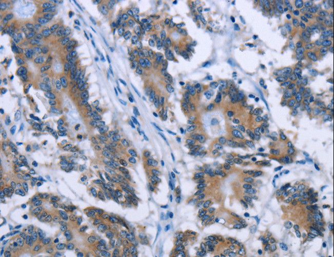 PLIN1 / Perilipin Antibody - Immunohistochemistry of paraffin-embedded Human colon cancer using PLIN1 Polyclonal Antibody at dilution of 1:30.