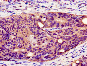 PLIN1 / Perilipin Antibody - Immunohistochemistry image of paraffin-embedded human colon cancer at a dilution of 1:100