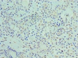 PLIN2 / ADFP / Adipophilin Antibody - Immunohistochemistry of paraffin-embedded human breast cancer using antibody at 1:100 dilution.