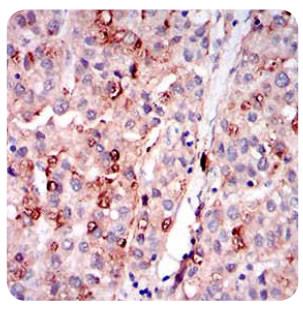 PLIN2 / ADFP / Adipophilin Antibody - Immunohistochemistry: ADFP Antibody (2C5A3) - IHC analysis of ADFP in paraffin-embedded human liver cancer tissues with DAB staining.  This image was taken for the unconjugated form of this product. Other forms have not been tested.