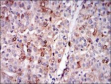 PLIN2 / ADFP / Adipophilin Antibody - IHC of paraffin-embedded liver cancer tissues using PLIN2 mouse monoclonal antibody with DAB staining.