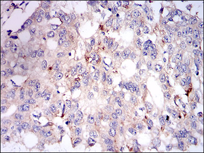 PLIN2 / ADFP / Adipophilin Antibody - IHC of paraffin-embedded esophageal cancer tissues using PLIN2 mouse monoclonal antibody with DAB staining.