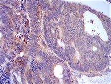 PLIN2 / ADFP / Adipophilin Antibody - IHC of paraffin-embedded rectum cancer tissues using PLIN2 mouse monoclonal antibody with DAB staining.