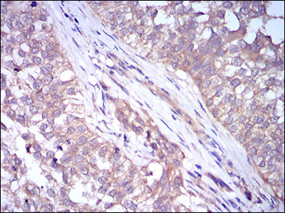 PLIN2 / ADFP / Adipophilin Antibody - IHC of paraffin-embedded bladder cancer tissues using PLIN2 mouse monoclonal antibody with DAB staining.