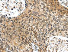 PLIN3 / M6PRBP1 / TIP47 Antibody - Immunohistochemistry of paraffin-embedded Human prostate cancer using PLIN3 Polyclonal Antibody at dilution of 1:40.