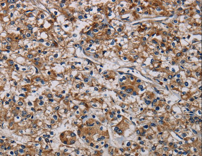 PLIN3 / M6PRBP1 / TIP47 Antibody - Immunohistochemistry of paraffin-embedded Human prostate cancer using PLIN3 Polyclonal Antibody at dilution of 1:40.