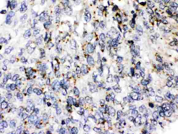 PLIN3 / M6PRBP1 / TIP47 Antibody - Perilipin 3 was detected in paraffin-embedded sections of human lung cancer tissues using rabbit anti- Perilipin 3 Antigen Affinity purified polyclonal antibody