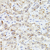 PLIN3 / M6PRBP1 / TIP47 Antibody - Immunohistochemistry of paraffin-embedded human liver cancer using PLIN3 antibody at dilution of 1:100 (40x lens).
