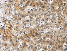 PLIN4 / S3-12 Antibody - Immunohistochemistry of paraffin-embedded Human liver cancer tissue  using PLIN4 Polyclonal Antibody at dilution of 1:50(×200)