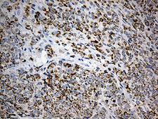 PLIN5 / OXPAT / LSDP5 Antibody - Immunohistochemical staining of paraffin-embedded Adenocarcinoma of Human breast tissue tissue using anti-PLIN5 mouse monoclonal antibody. (Heat-induced epitope retrieval by 1mM EDTA in 10mM Tris buffer. (pH8.5) at 120°C for 3 min. (1:500)