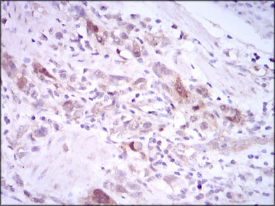 PLK1 / PLK-1 Antibody - IHC of paraffin-embedded stomach cancer tissues using PLK1 mouse monoclonal antibody with DAB staining.