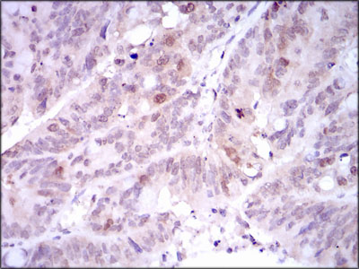 PLK1 / PLK-1 Antibody - IHC of paraffin-embedded rectum cancer tissues using PLK1 mouse monoclonal antibody with DAB staining.