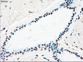 PLK1 / PLK-1 Antibody - Immunohistochemical staining of paraffin-embedded breast tissue using anti-PLK1 mouse monoclonal antibody. (Dilution 1:50).
