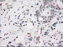 PLK1 / PLK-1 Antibody - Immunohistochemical staining of paraffin-embedded Adenocarcinoma of colon tissue using anti-PLK1 mouse monoclonal antibody. (Dilution 1:50).