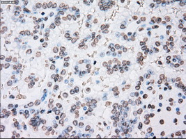 PLK1 / PLK-1 Antibody - Immunohistochemical staining of paraffin-embedded Carcinoma of kidney tissue using anti-PLK1 mouse monoclonal antibody. (Dilution 1:50).