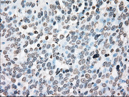 PLK1 / PLK-1 Antibody - Immunohistochemical staining of paraffin-embedded Adenocarcinoma of ovary tissue using anti-PLK1 mouse monoclonal antibody. (Dilution 1:50).