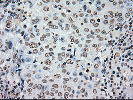 PLK1 / PLK-1 Antibody - IHC of paraffin-embedded Adenocarcinoma of breast tissue using anti-PLK1 mouse monoclonal antibody. (Dilution 1:50).