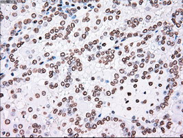 PLK1 / PLK-1 Antibody - IHC of paraffin-embedded Carcinoma of kidney tissue using anti-PLK1 mouse monoclonal antibody. (Dilution 1:50).