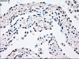 PLK1 / PLK-1 Antibody - IHC of paraffin-embedded Carcinoma of lung tissue using anti-PLK1 mouse monoclonal antibody. (Dilution 1:50).