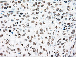 PLK1 / PLK-1 Antibody - IHC of paraffin-embedded Carcinoma of pancreas tissue using anti-PLK1 mouse monoclonal antibody. (Dilution 1:50).