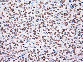 PLK1 / PLK-1 Antibody - IHC of paraffin-embedded Carcinoma of thyroid tissue using anti-PLK1 mouse monoclonal antibody. (Dilution 1:50).