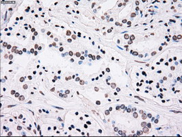 PLK1 / PLK-1 Antibody - IHC of paraffin-embedded Carcinoma of prostate tissue using anti-PLK1 mouse monoclonal antibody. (Dilution 1:50).