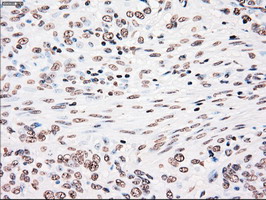 PLK1 / PLK-1 Antibody - IHC of paraffin-embedded Carcinoma of bladder tissue using anti-PLK1 mouse monoclonal antibody. (Dilution 1:50).