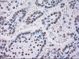 PLK1 / PLK-1 Antibody - IHC of paraffin-embedded Carcinoma of kidney tissue using anti-PLK1 mouse monoclonal antibody. (Dilution 1:50).