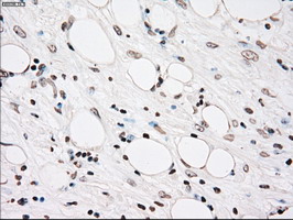 PLK1 / PLK-1 Antibody - IHC of paraffin-embedded Carcinoma of pancreas tissue using anti-PLK1 mouse monoclonal antibody. (Dilution 1:50).