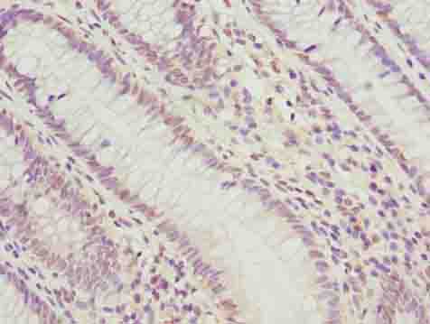 PLK1 / PLK-1 Antibody - Immunohistochemistry of paraffin-embedded human colon cancer using antibody at dilution of 1:100.