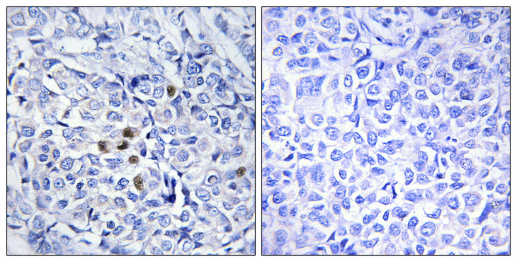 PLK1 / PLK-1 Antibody - Immunohistochemistry analysis of paraffin-embedded human breast carcinoma, using PLK1 (Phospho-Thr210) Antibody. The picture on the right is blocked with the phospho peptide.