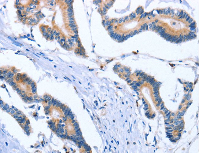 PLK3 Antibody - Immunohistochemistry of paraffin-embedded Human colon cancer using PLK3 Polyclonal Antibody at dilution of 1:30.