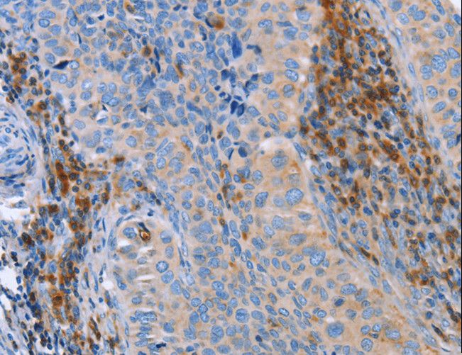 PLK3 Antibody - Immunohistochemistry of paraffin-embedded Human cervical cancer using PLK3 Polyclonal Antibody at dilution of 1:40.