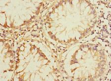 PLK3 Antibody - Immunohistochemistry of paraffin-embedded human colon cancer at dilution 1:100