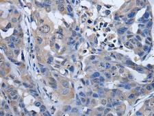 PLK4 / SAK Antibody - Immunohistochemistry of paraffin-embedded Human breast cancer tissue  using PLK4 Polyclonal Antibody at dilution of 1:50(×200)